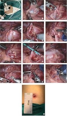 Comparison of robot-assisted single-port-plus-one pyeloplasty vs. laparoscopic single-port pyeloplasty in the treatment of ureteropelvic junction obstruction in children